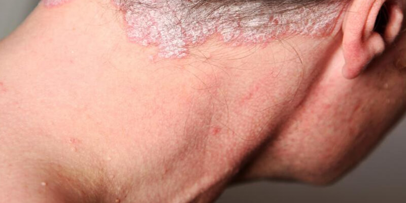 croste sul cuoio capelluto rimedi naturali