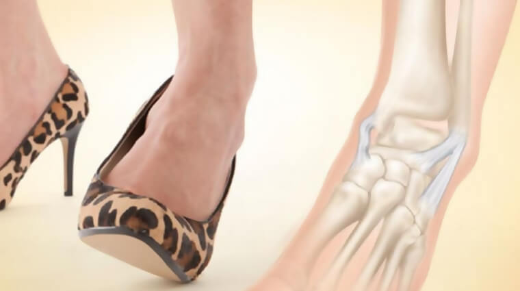 distorsione piede ematoma