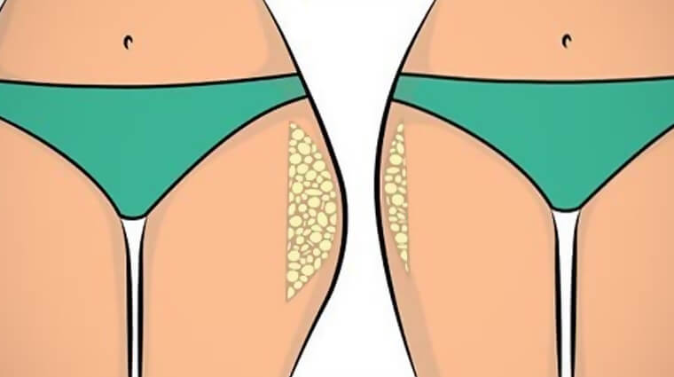 liposuzione culotte de cheval prezzi