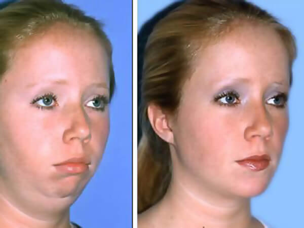 mentoplastica prima e dopo