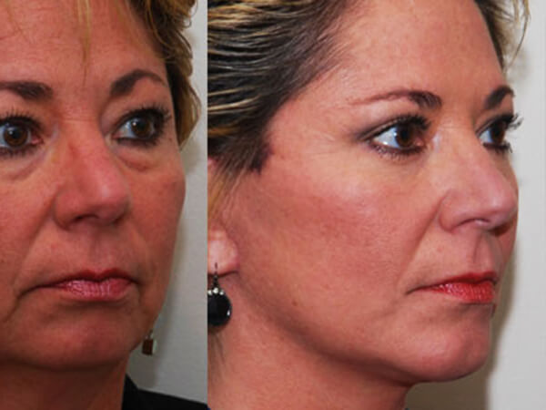 mentoplastica prima e dopo