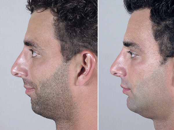 mentoplastica prima e dopo