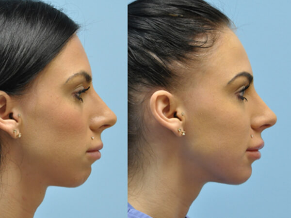 mentoplastica prima e dopo