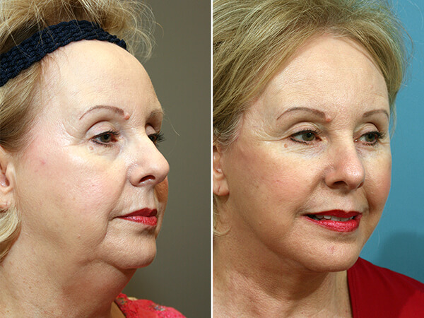 mentoplastica prima e dopo