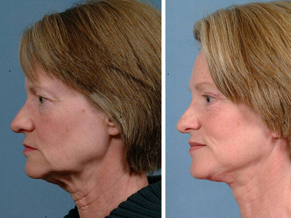 mentoplastica prima e dopo