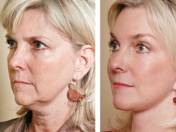 mentoplastica prima e dopo