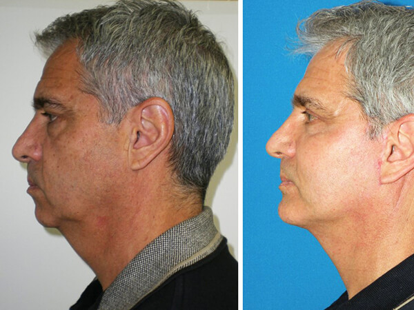 mentoplastica prima e dopo