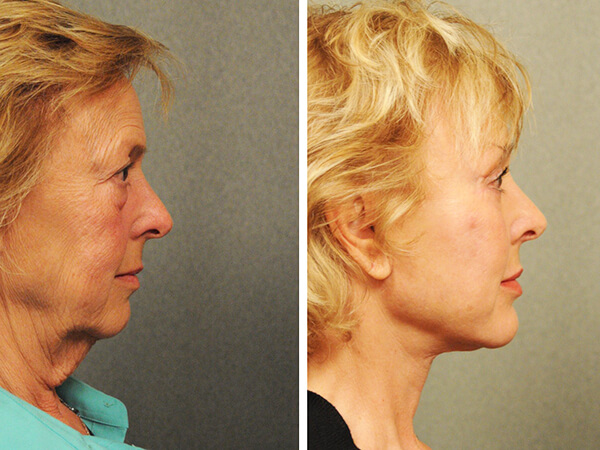 mentoplastica prima e dopo