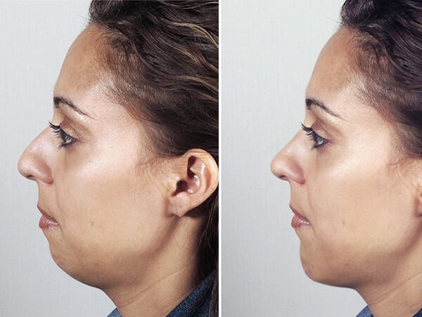 mentoplastica prima e dopo