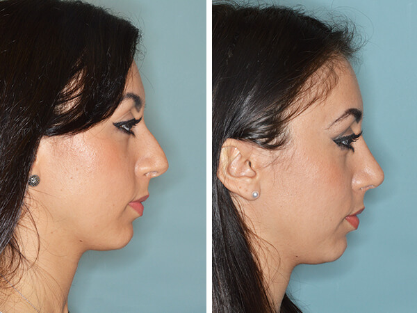 mentoplastica prima e dopo