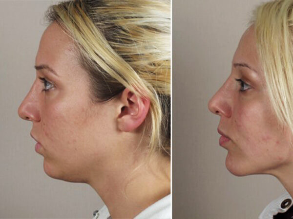 mentoplastica prima e dopo