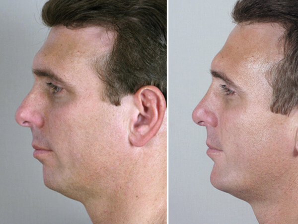 mentoplastica prima e dopo