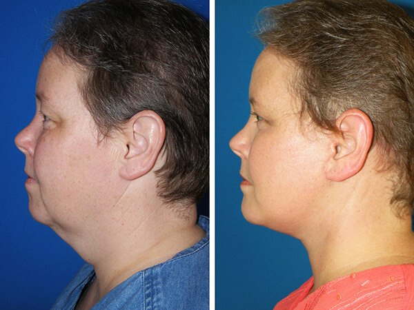 mentoplastica prima e dopo