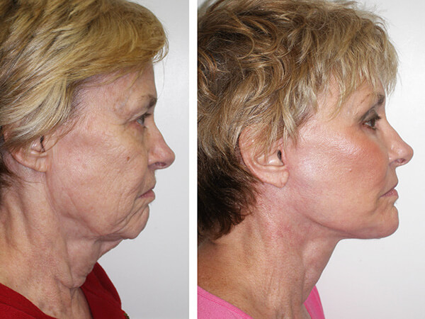 mentoplastica prima e dopo