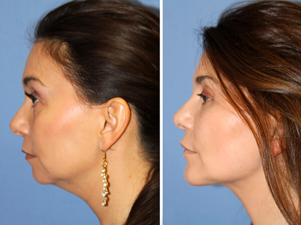 mentoplastica prima e dopo