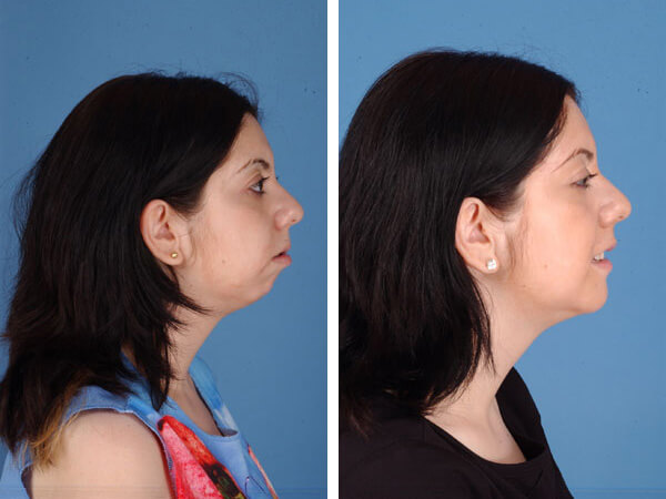 mentoplastica prima e dopo