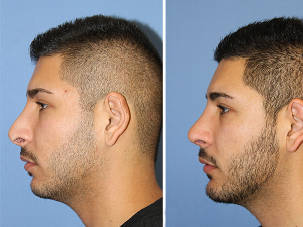 mentoplastica prima e dopo