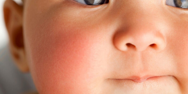 rimedi naturali e cura dell impetigine