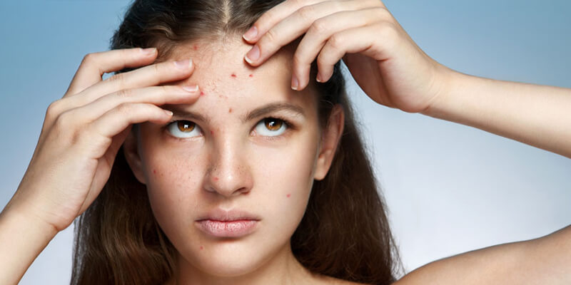 Rimedi per acne giovanile
