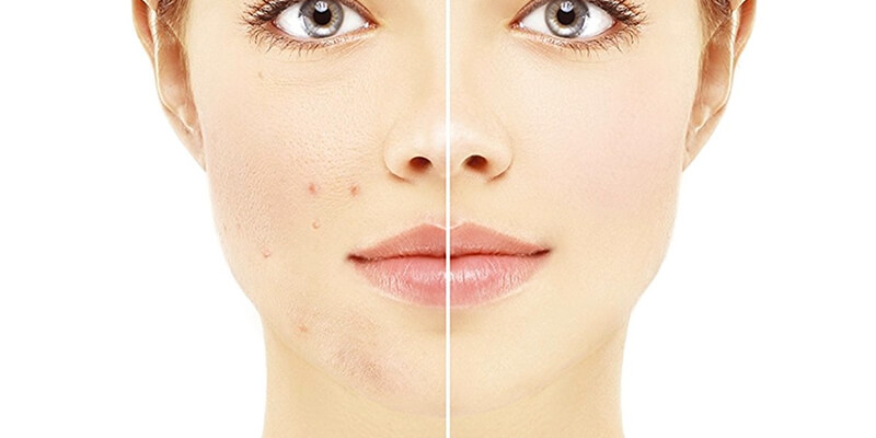 Vitamina A contro acne, ma non solo...