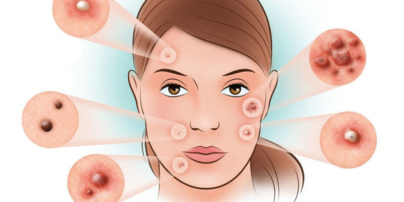 tipologie-di-acne-e-relative-cause.jpg
